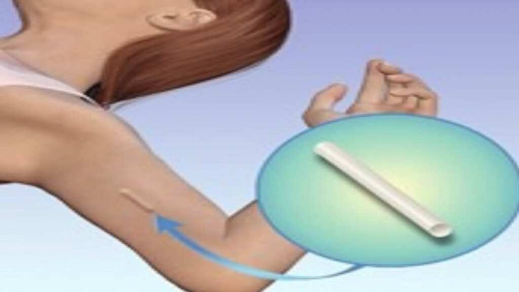 غرسات منع الحمل - وسائل منع الحمل